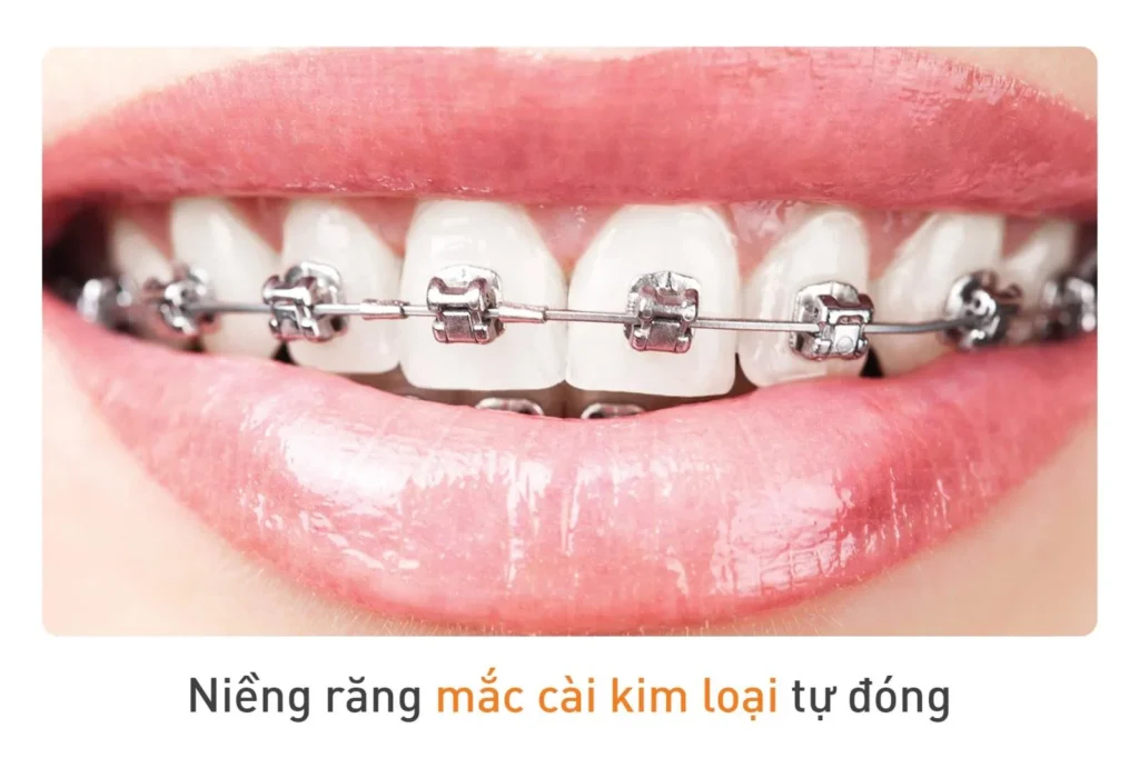 Niềng răng mắc cài tự buộc là gì? Có mấy loại, giá bao nhiêu 6 niềng răng mắc cài tự buộc