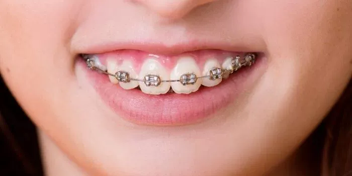 niềng răng mất bao lâu