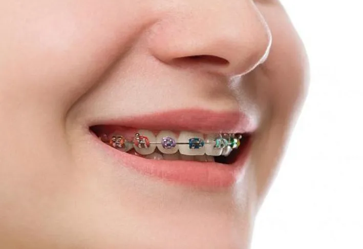 Niềng răng móm có được không? Thời gian và chi phí 5 niềng răng móm