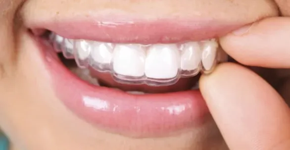 niềng răng trong suốt giá bao nhiêu
