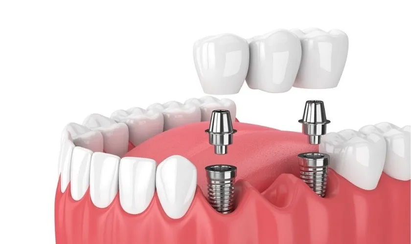 Trồng răng Implant bao lâu thì lành? 3 cách giúp mau lành 12 Trồng răng Implant bao lâu thì lành