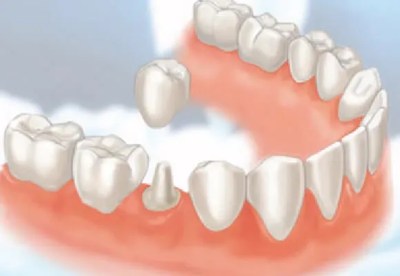 Bọc răng sứ thẩm mỹ có đau không