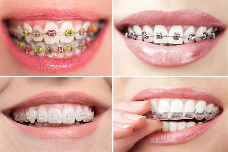 Các loại niềng răng phổ biến và ưu nhược điểm từng loại