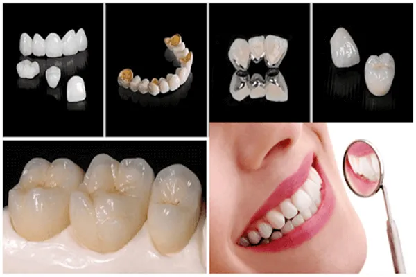 Các loại răng sứ phổ biến hiện nay