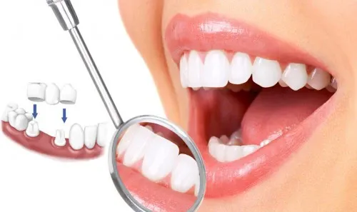 Các trường hợp nên bọc răng sứ thẩm mỹ