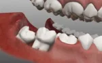 Răng khôn mọc ngầm: Dấu hiệu nhận biết sớm và điều trị 6 Cần làm gì khi có răng khôn mọc ngầm