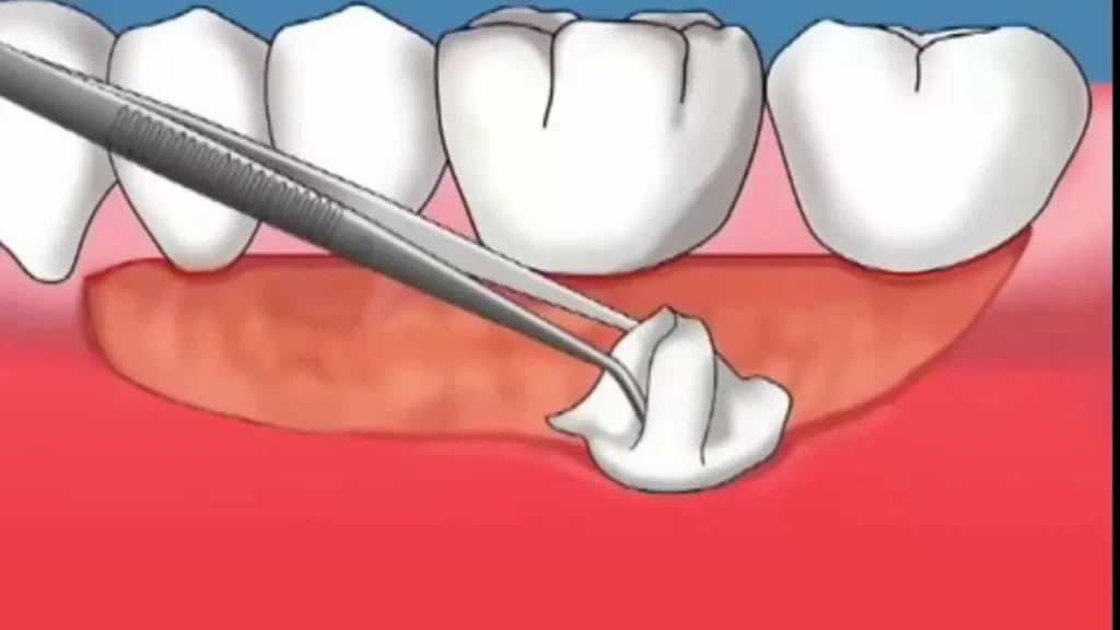 Cắt, ghép vạt lợi