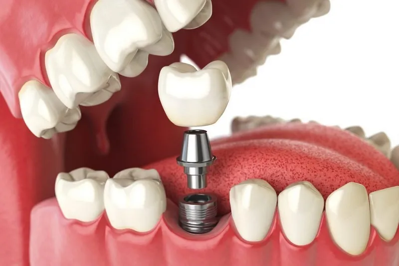 Cấy răng Implant