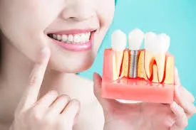 Trồng răng hàm bị sâu giá bao nhiêu? Giá từng phương pháp 12 Chăm sóc sau khi trồng răng hàm