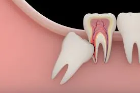 Có nên loại bỏ răng khôn