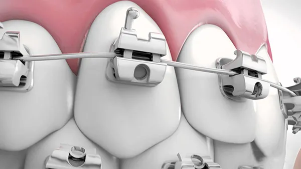 Mắc cài tự đóng