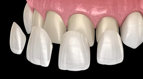 Mặt dán sứ Veneers 