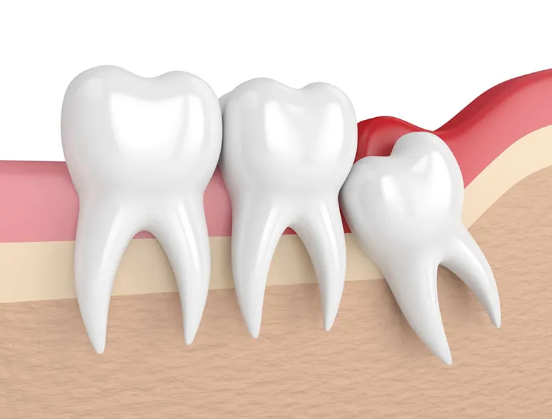 Mọc răng khôn hàm dưới : Dấu hiệu nhận biết và cách xử lý