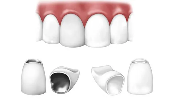 Bọc sứ 2 răng cửa giá bao nhiêu tiền? Mức chi phí mới nhất 7 Nên lựa chọn loại răng sứ nào cho răng cửa