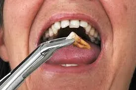 Răng khôn mọc ngang có nguy hiểm không? Có nên nhổ không 7 Nhổ răng khôn mọc ngang có nguy hiểm không