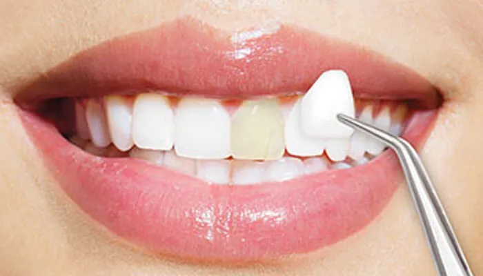 Những vấn đề răng miệng nào có thể khắc phục bằng mặt dán Veneer 