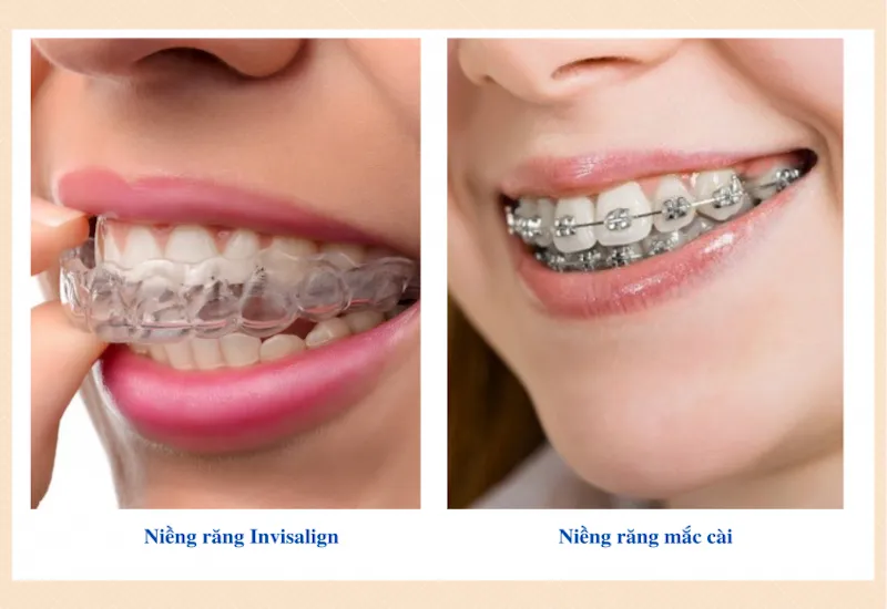 Niềng răng không mắc cài