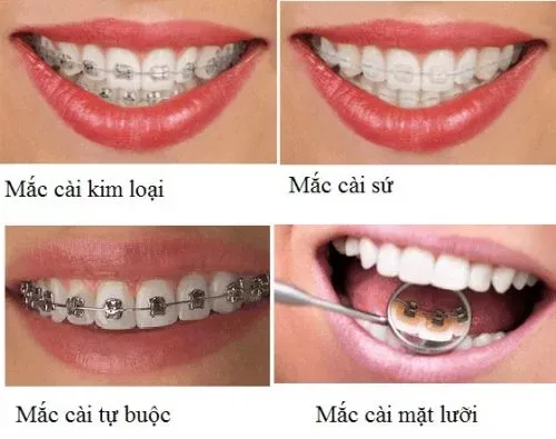 Niềng răng loại nào tốt nhất