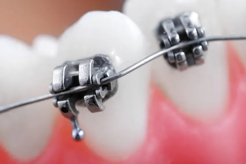 Niềng răng mắc cài tự buộc