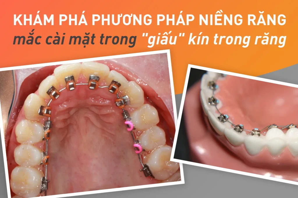 Niềng răng mặt trong là gì? Ưu nhược điểm? Chi phí và lưu ý 8 Niềng răng mặt trong bao nhiêu tiền