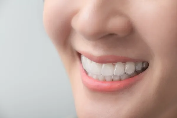 Niềng răng trong suốt