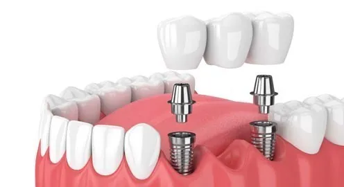 Trồng răng hàm bị sâu giá bao nhiêu? Giá từng phương pháp 11 Trồng răng hàm bị sâu giá bao nhiêu? Phương pháp trồng răng implant