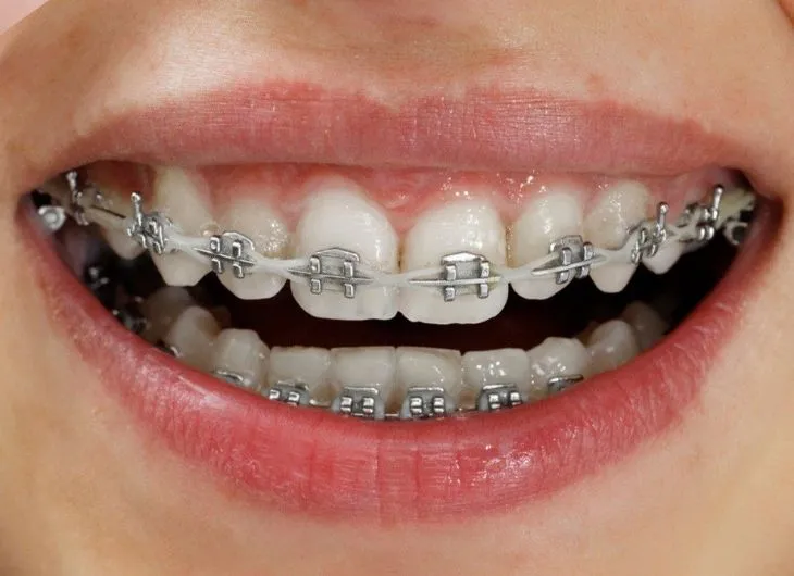 Quy trình niềng răng mắc cài kim loại thường
