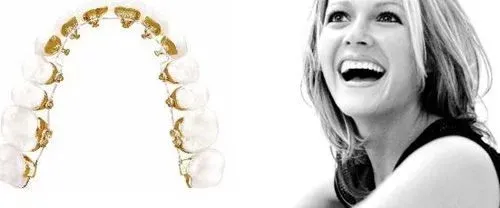 Niềng răng mặt trong là gì? Ưu nhược điểm? Chi phí và lưu ý 6 Quy trình niềng răng mặt trong