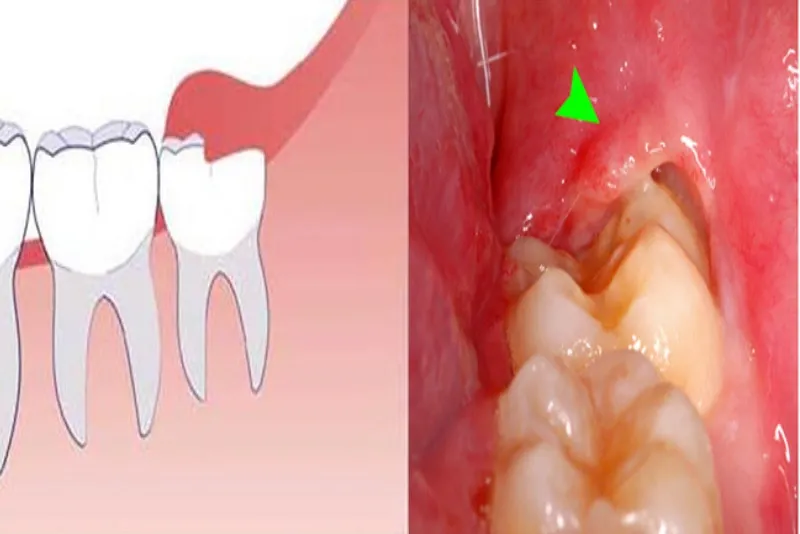 Không nhổ răng khôn có sao không? Có nguy hiểm gì không? 5 Răng khôn là gì