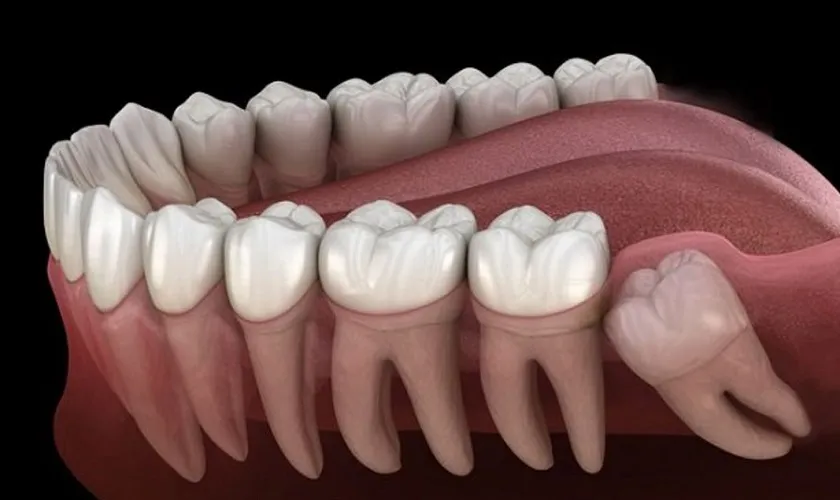 Răng khôn là răng số mấy? 1 người có bao nhiêu răng khôn?