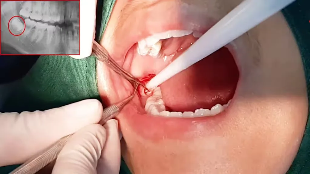 Tại sao nhổ răng khôn bị đau