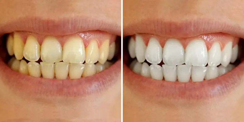 Tẩy trắng răng