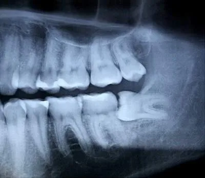 Răng khôn mọc ngang có nguy hiểm không? Có nên nhổ không 6 Triệu chứng nhận biết khi mọc răng khôn nằm ngang