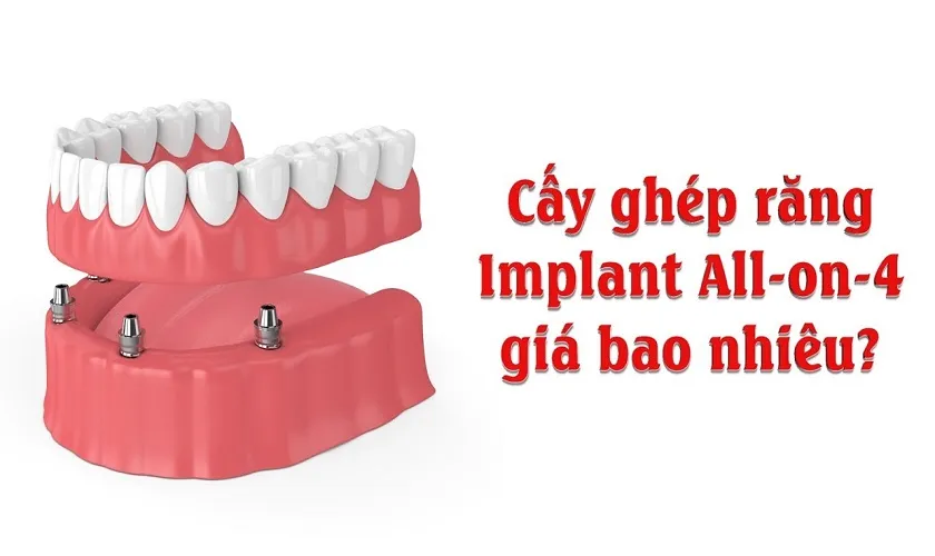 Trồng răng Implant All on 4 giá bao nhiêu