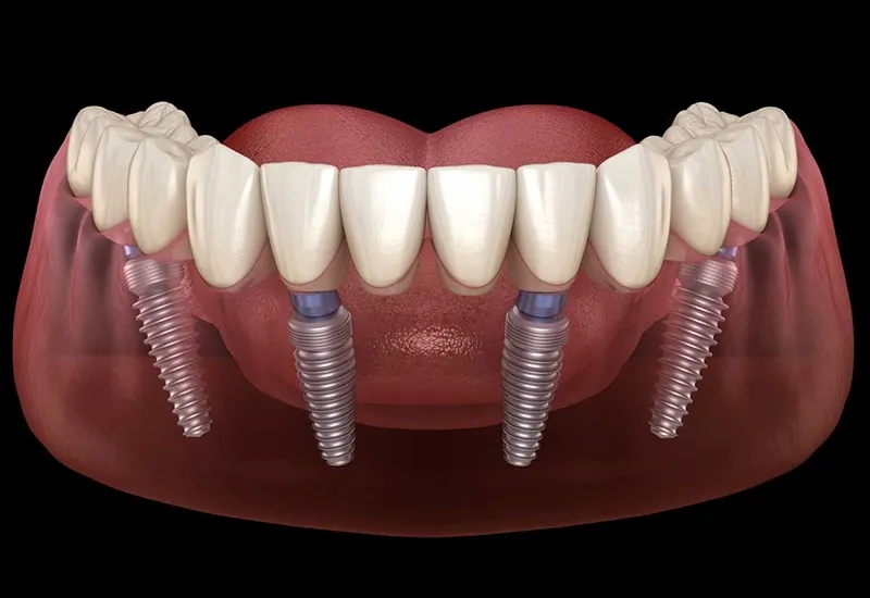 Trồng răng Implant All on 4 là gì? Ưu nhược điểm và giá