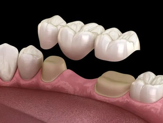 Trồng răng giả là gì? 3 phương pháp trồng răng giả phổ biến 10 Trồng răng giả bằng cầu răng sứ