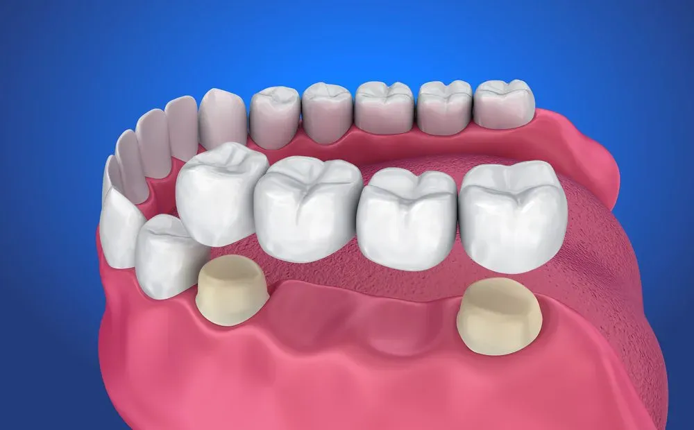 Các phương pháp trồng răng giả cố định tốt nhất hiện nay 7 Trồng răng giả cố định bằng cầu sứ
