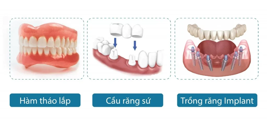 Các phương pháp trồng răng giả cố định tốt nhất hiện nay 10 Trồng răng giả cố định loại nào tốt nhất