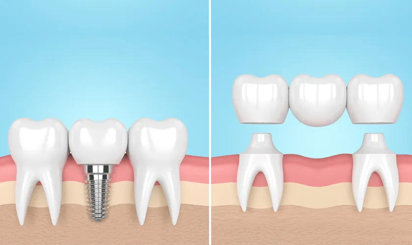 Các phương pháp trồng răng giả cố định tốt nhất hiện nay
