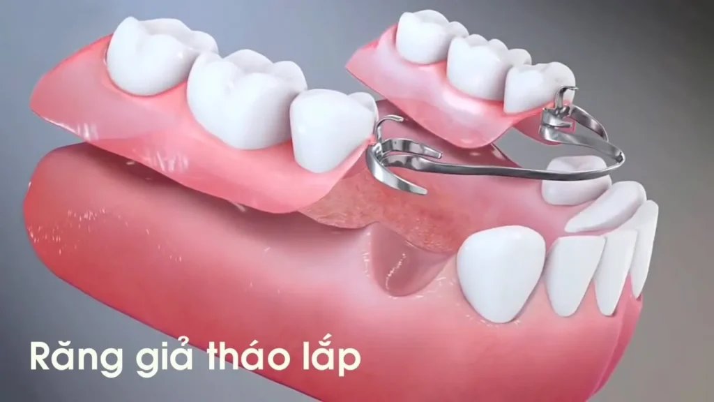 Trồng răng giả là gì? 3 phương pháp trồng răng giả phổ biến 9 Trồng răng giả tháo lắp