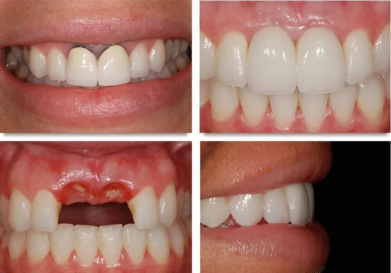 Trồng răng giả là gì? 3 phương pháp trồng răng giả phổ biến