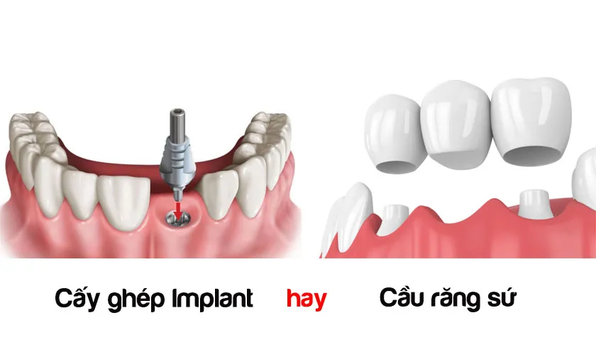 Trồng răng hàm bị sâu giá bao nhiêu? Giá từng phương pháp 10 Trồng răng hàm bị sâu giá bao nhiêu? Trồng răng hàm bằng cầu răng sứ