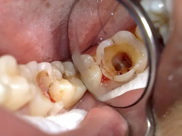 Trồng răng hàm bị sâu giá bao nhiêu? Giá từng phương pháp