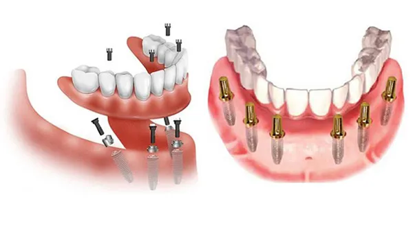 Cấy ghép Implant All On 6 là gì? Chi phí thực hiện bao nhiêu tiền?