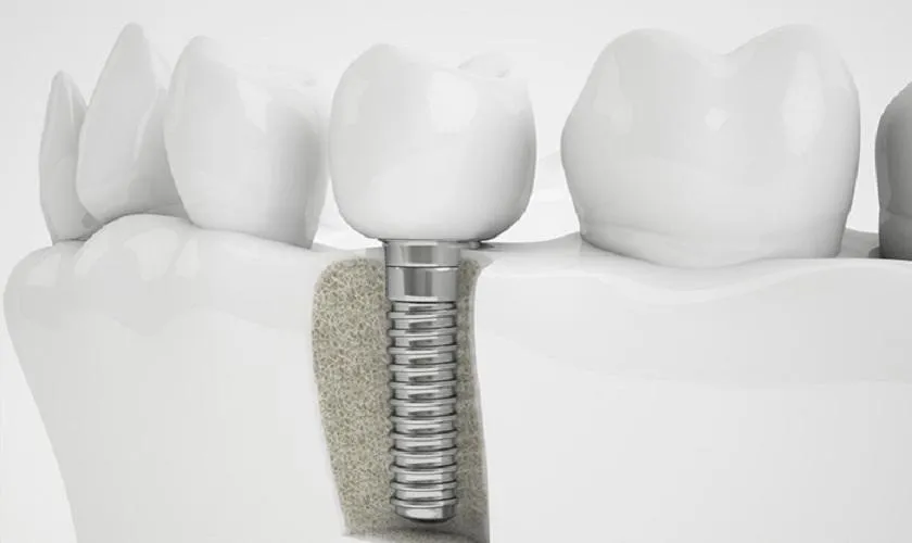 Flapless Implant là gì? Ưu nhược điểm của kĩ thuật này