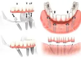 Ưu điểm của phương pháp trồng răng All on 4