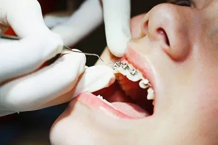 Ưu nhược điểm của mắc cài kim loại thường