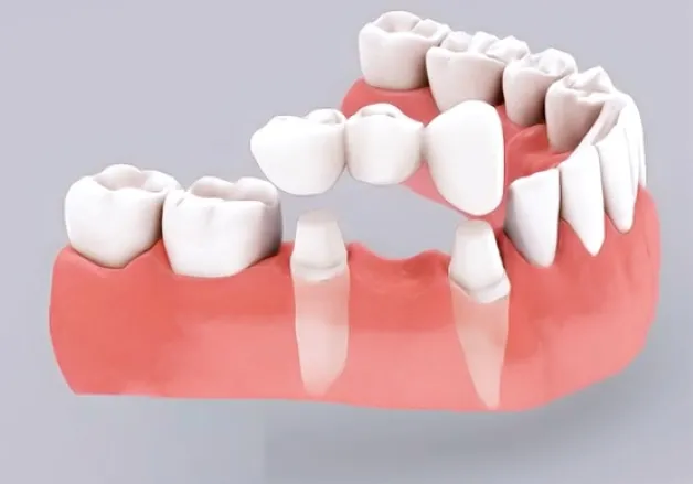Các phương pháp trồng răng giả cố định tốt nhất hiện nay 9 Ưu nhược điểm của phương pháp trồng răng giả cố định implant