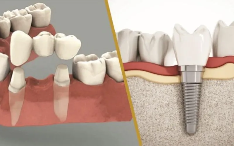 Các phương pháp trồng răng giả cố định tốt nhất hiện nay 8 Ưu và nhược điểm của phương pháp trồng răng giả cố định bằng cầu sứ
