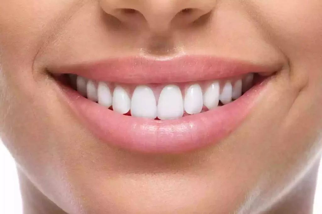 Veneers composite